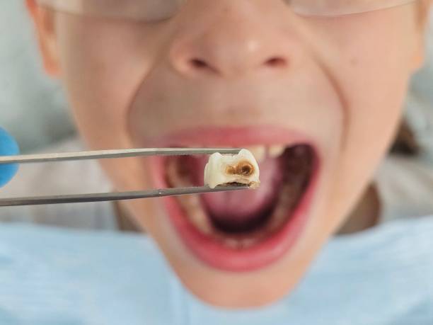 Best Emergency Treatment for Dental Infections or Abscesses in Wyanet, IL
